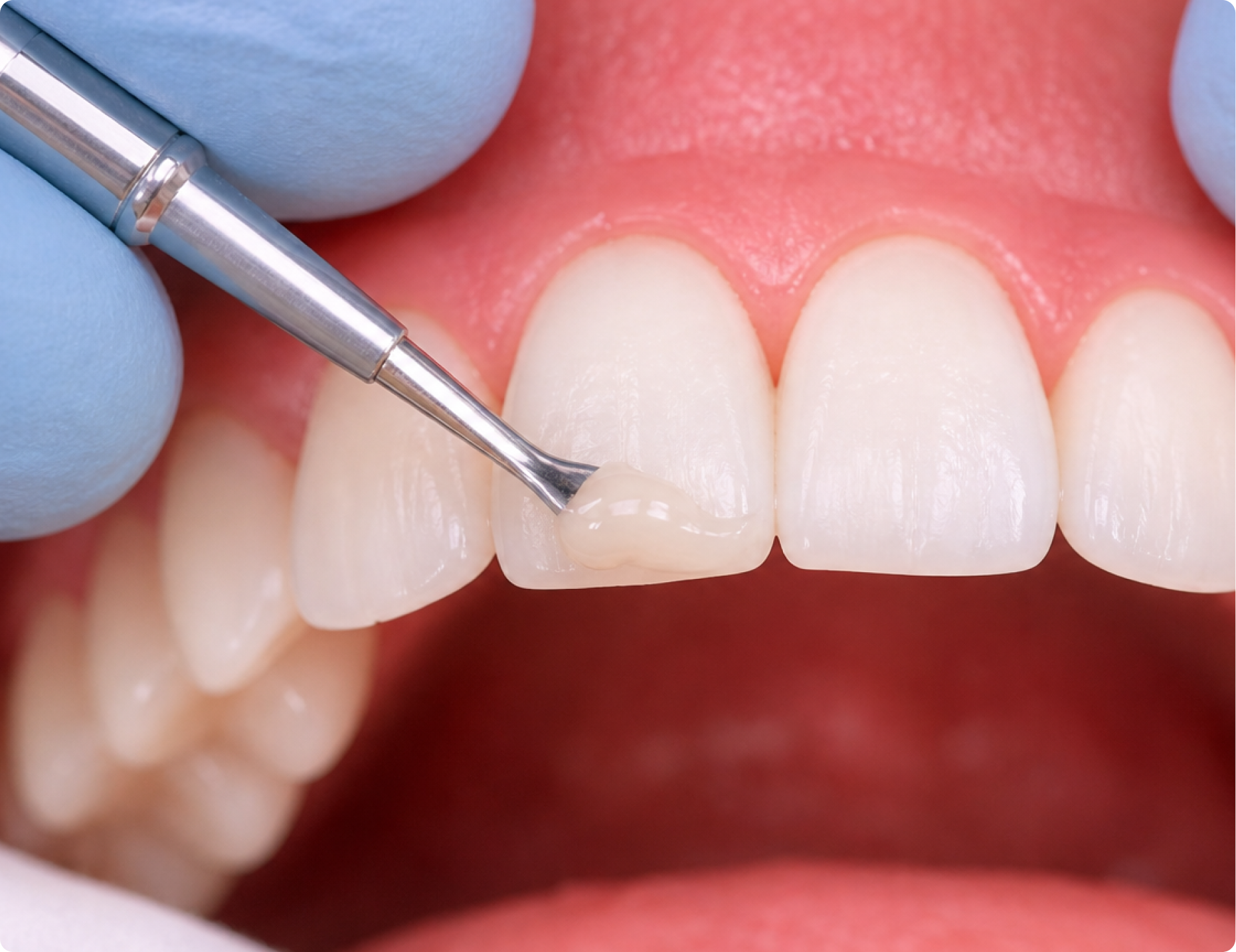 Composite bonding procedure