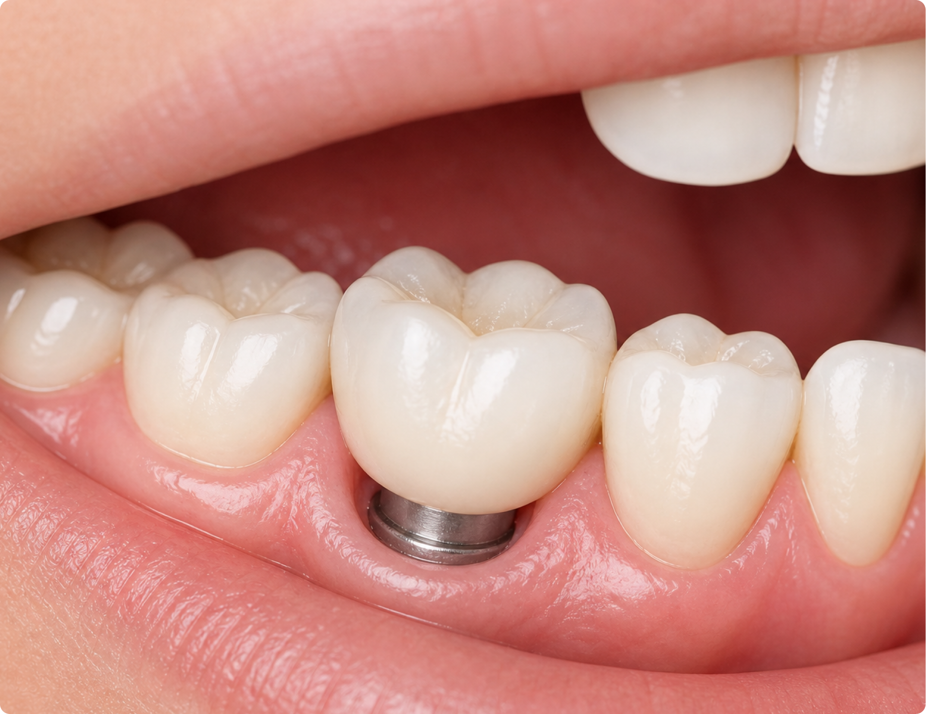 Dental implant procedure