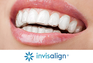 Invisalign